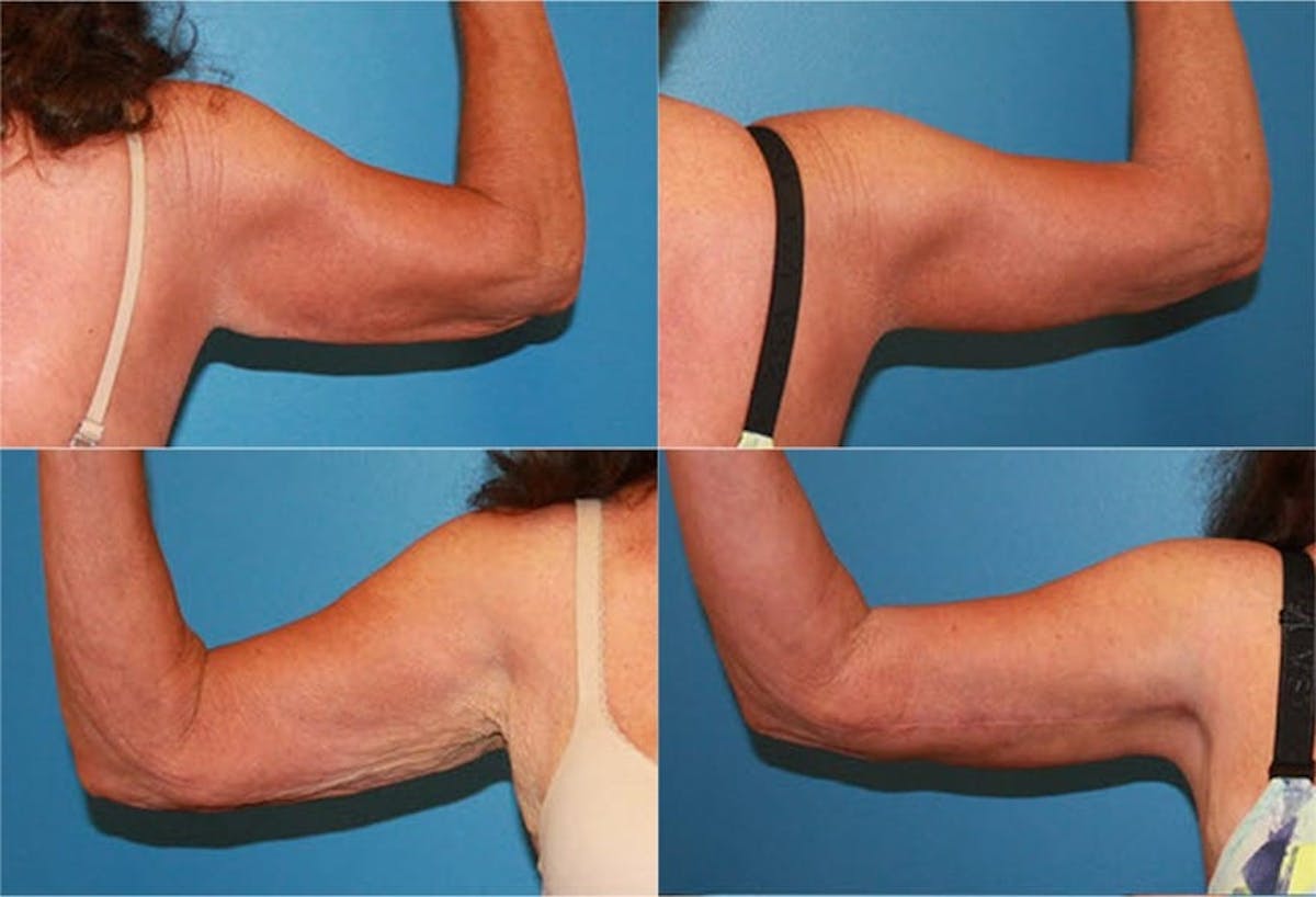 Arm Lift Before & After Gallery - Patient 263037 - Image 1