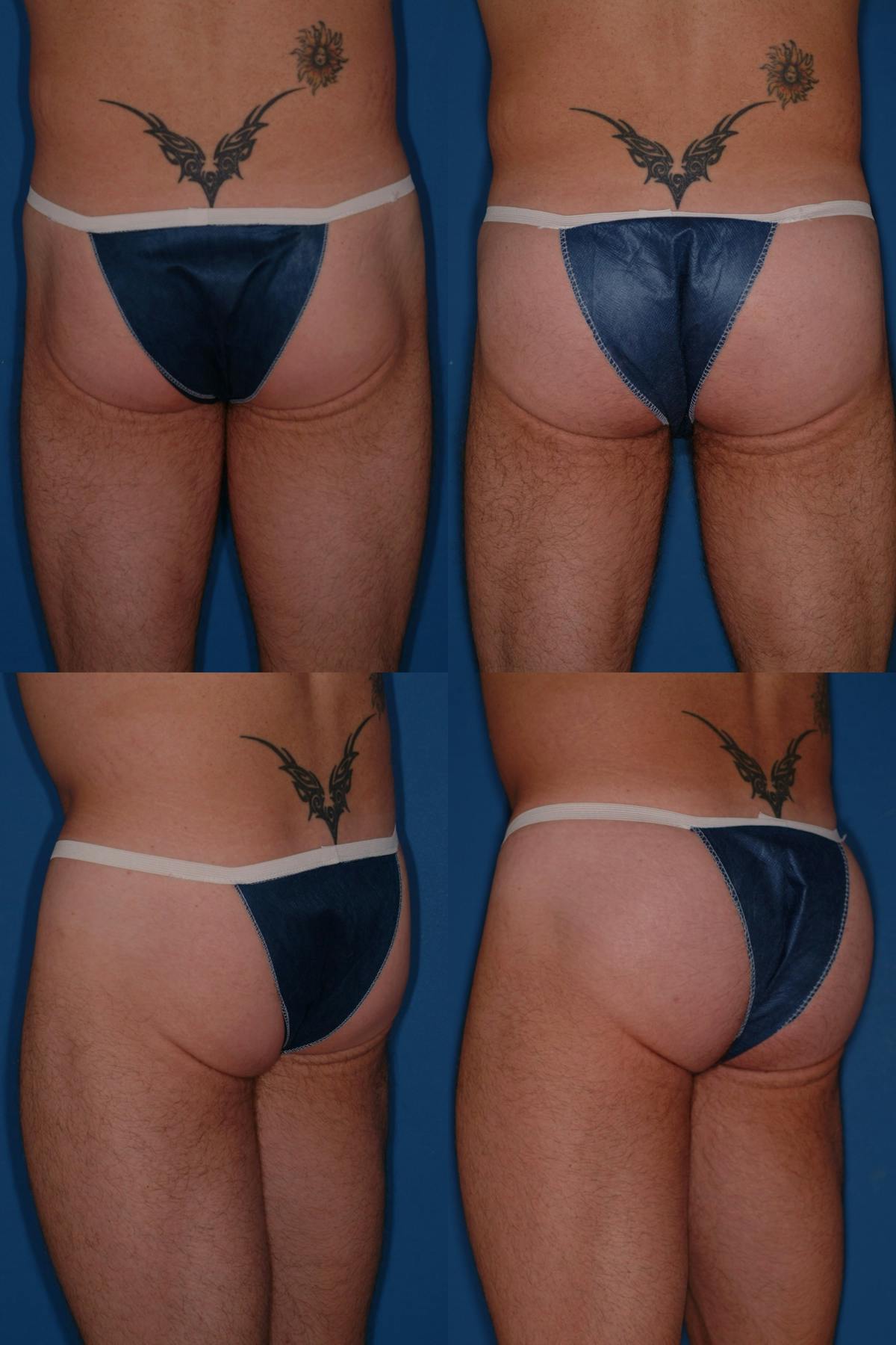 Buttock Augmentation with Implants Before & After Gallery - Patient 153895 - Image 1