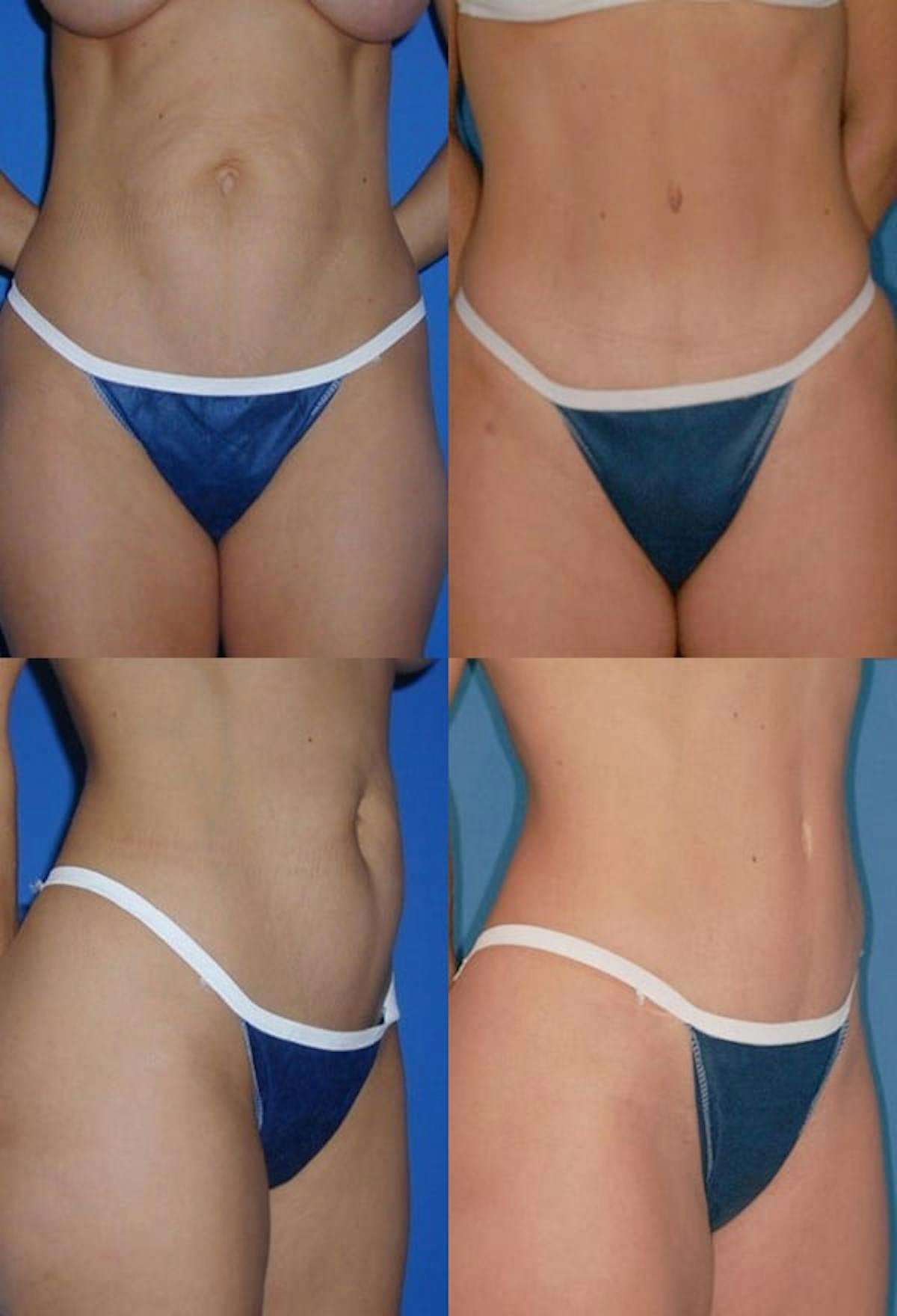 Tummy Tuck Before & After Gallery - Patient 375128 - Image 1