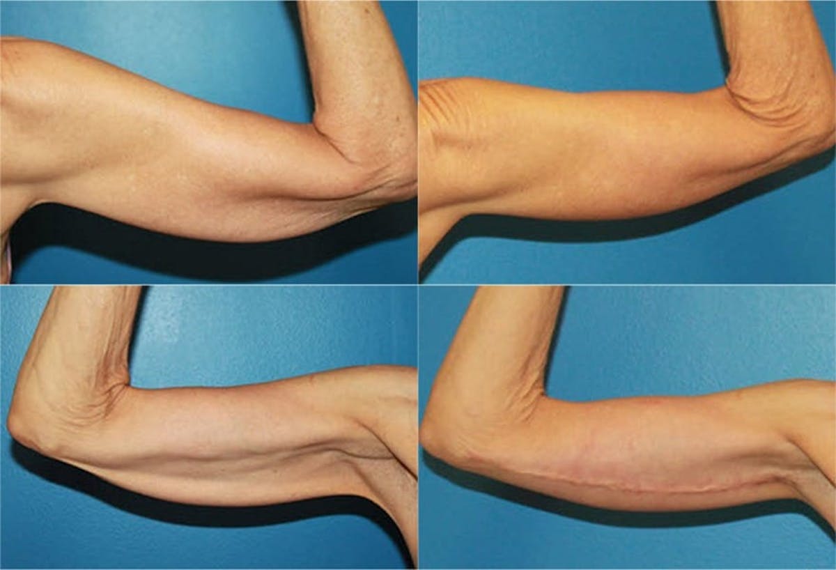 Arm Lift Before & After Gallery - Patient 246027 - Image 1