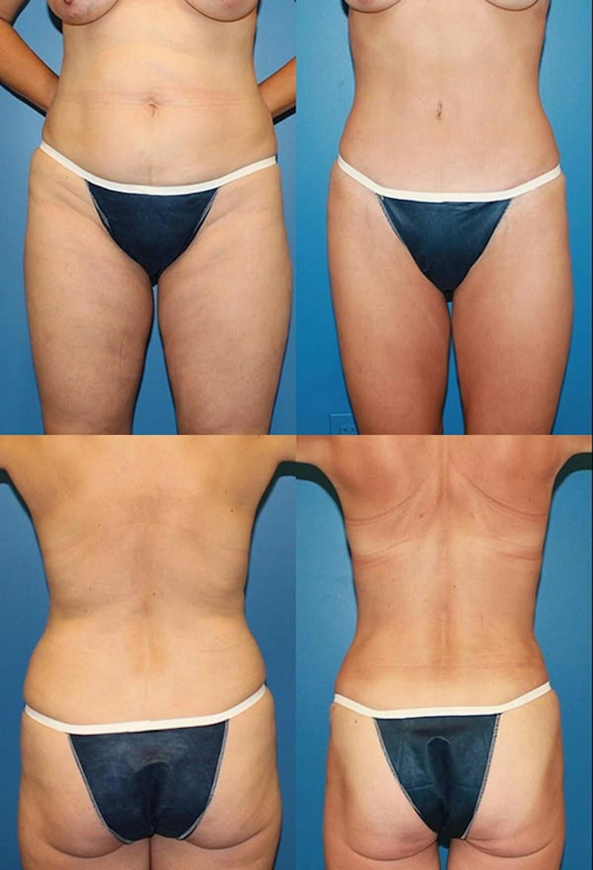 Tummy Tuck Before & After Gallery - Patient 220021 - Image 1