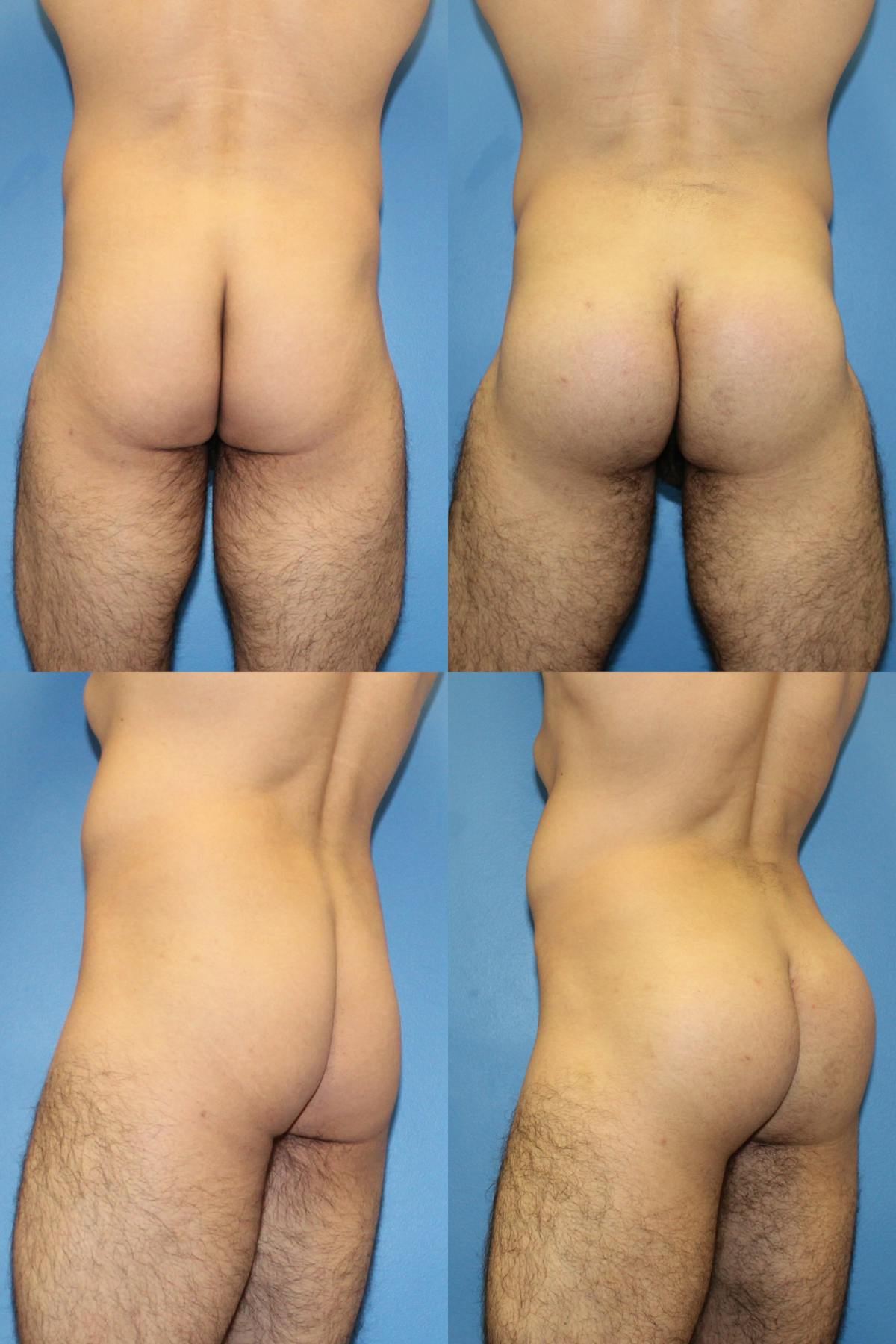 Buttock Augmentation with Implants Before & After Gallery - Patient 308346 - Image 1