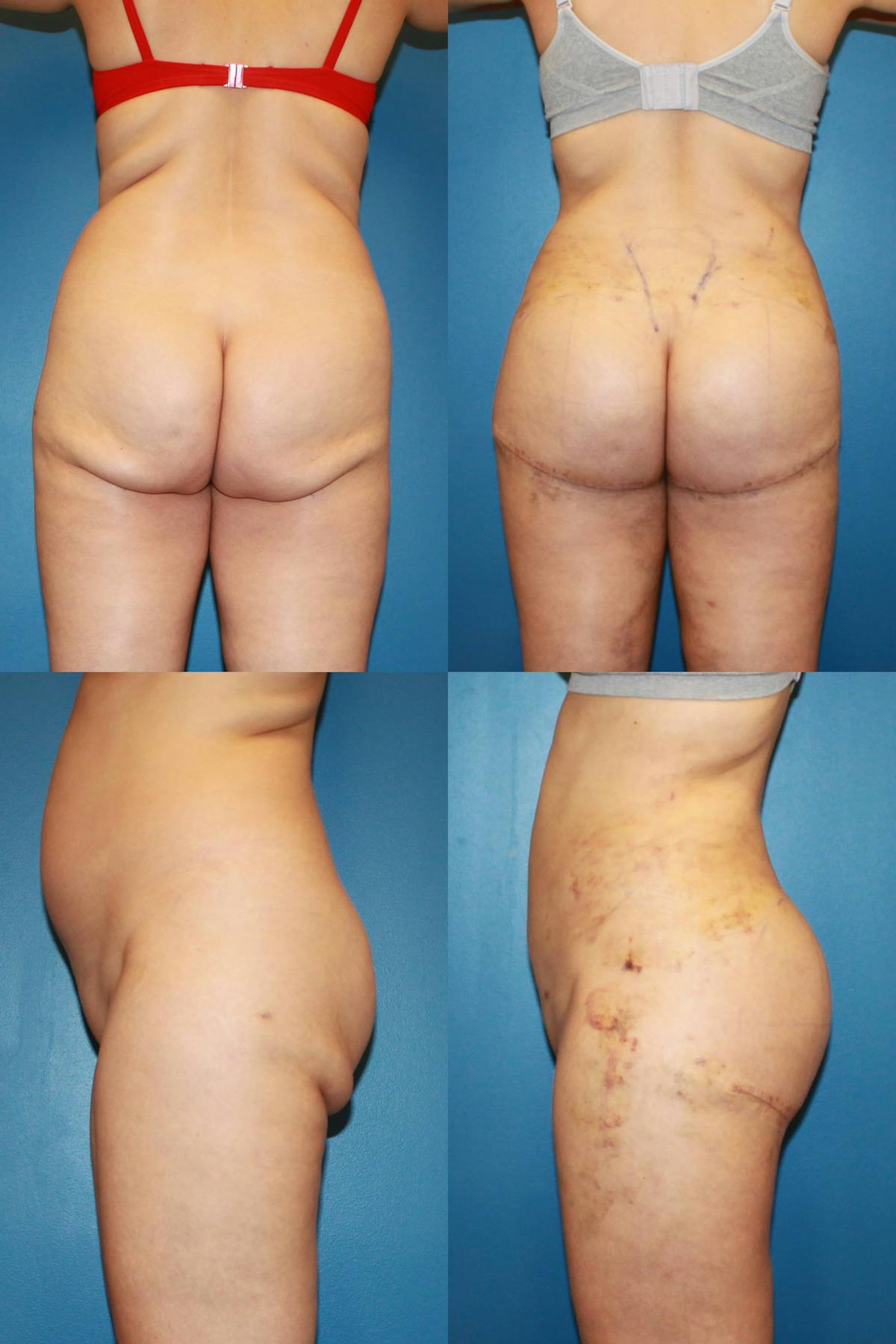 Thong Lift / Infragluteal Thigh Lift Before & After Gallery - Patient 386901 - Image 1