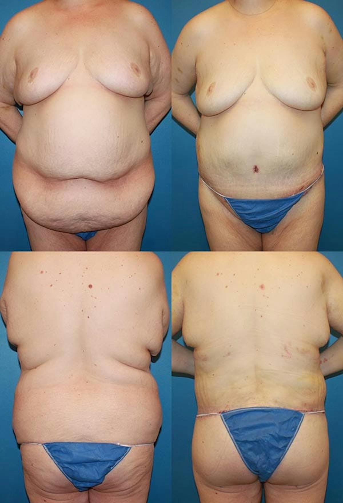 Body Lift / Thigh Lift Before & After Gallery - Patient 326700 - Image 1