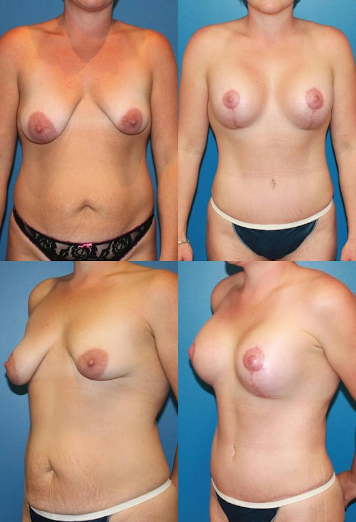 Tummy Tuck Before & After Gallery - Patient 720830 - Image 1