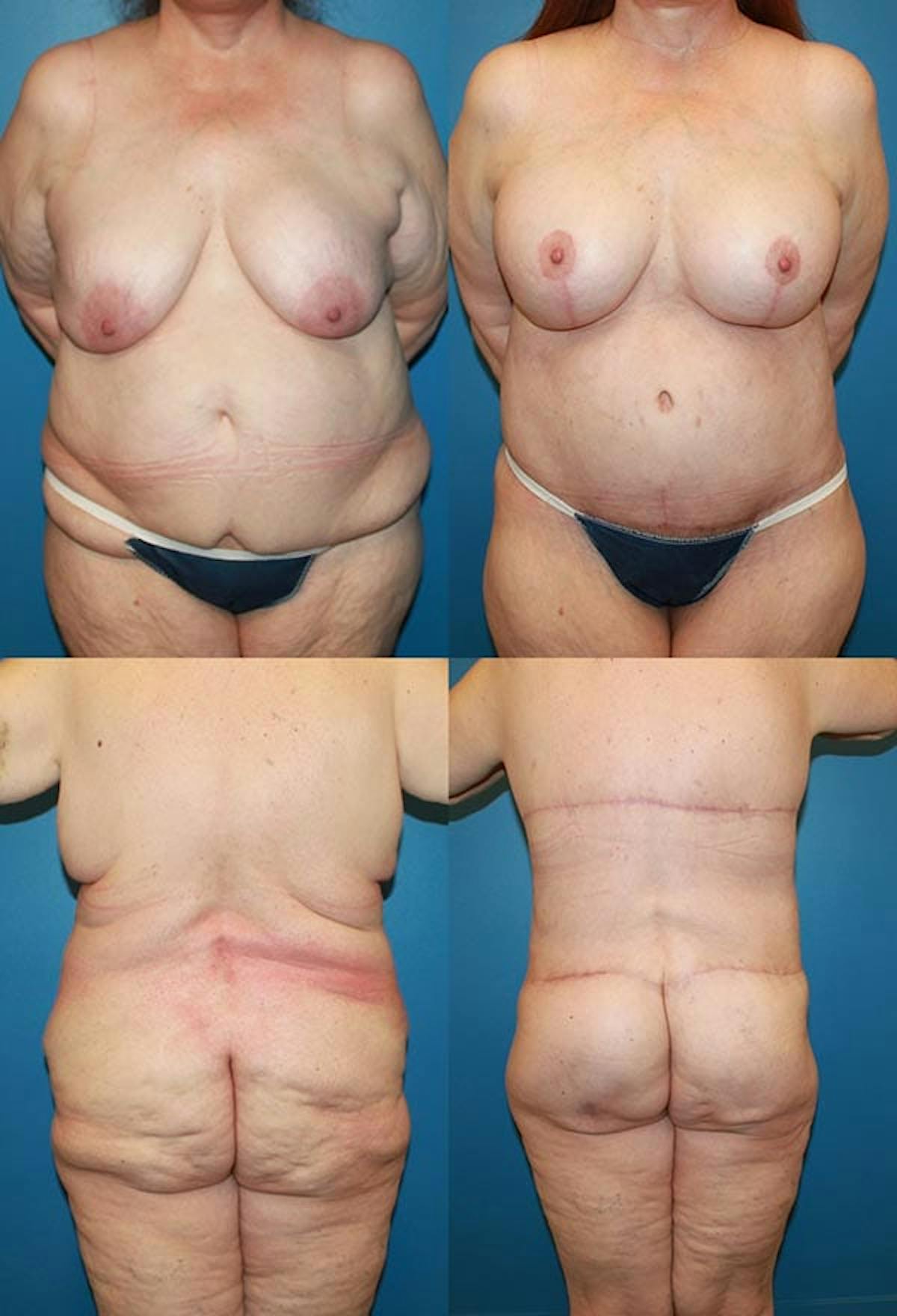 Body Lift / Thigh Lift Before & After Gallery - Patient 526172 - Image 1