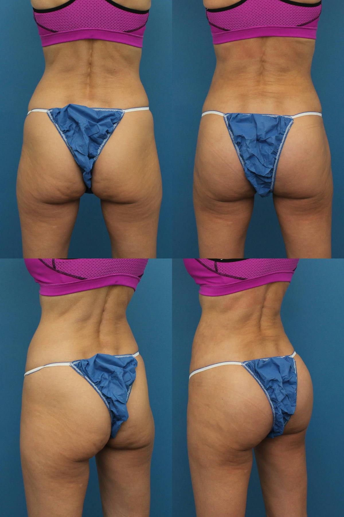 Buttock Augmentation with Implants Before & After Gallery - Patient 349218 - Image 1