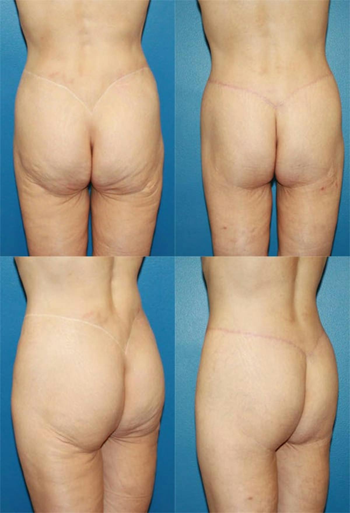 Body Lift / Thigh Lift Before & After Gallery - Patient 168273 - Image 1