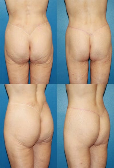 Body Lift / Thigh Lift Before & After Gallery - Patient 168273 - Image 1