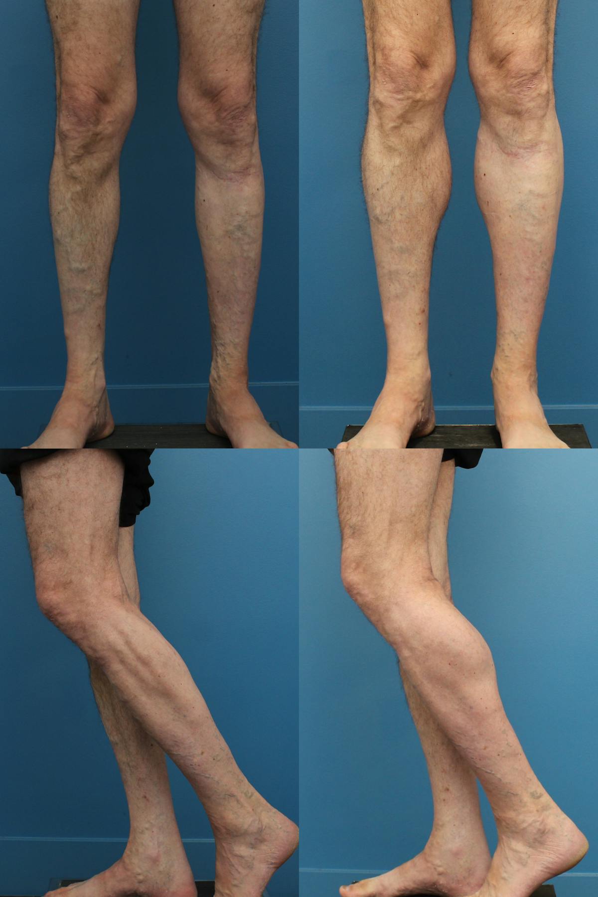 Calf Augmentation Before & After Gallery - Patient 274386 - Image 1