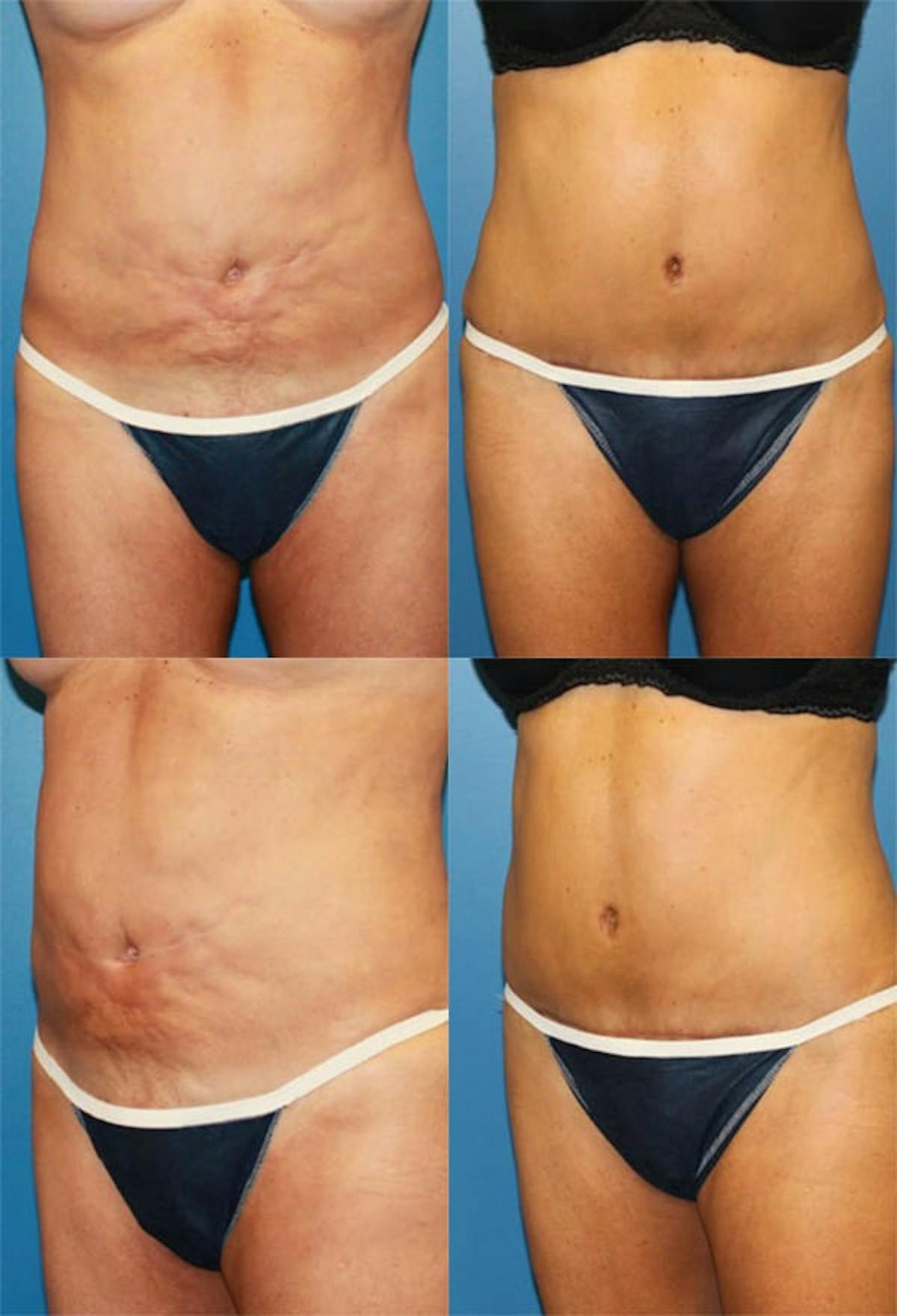 Tummy Tuck Before & After Gallery - Patient 206069 - Image 1