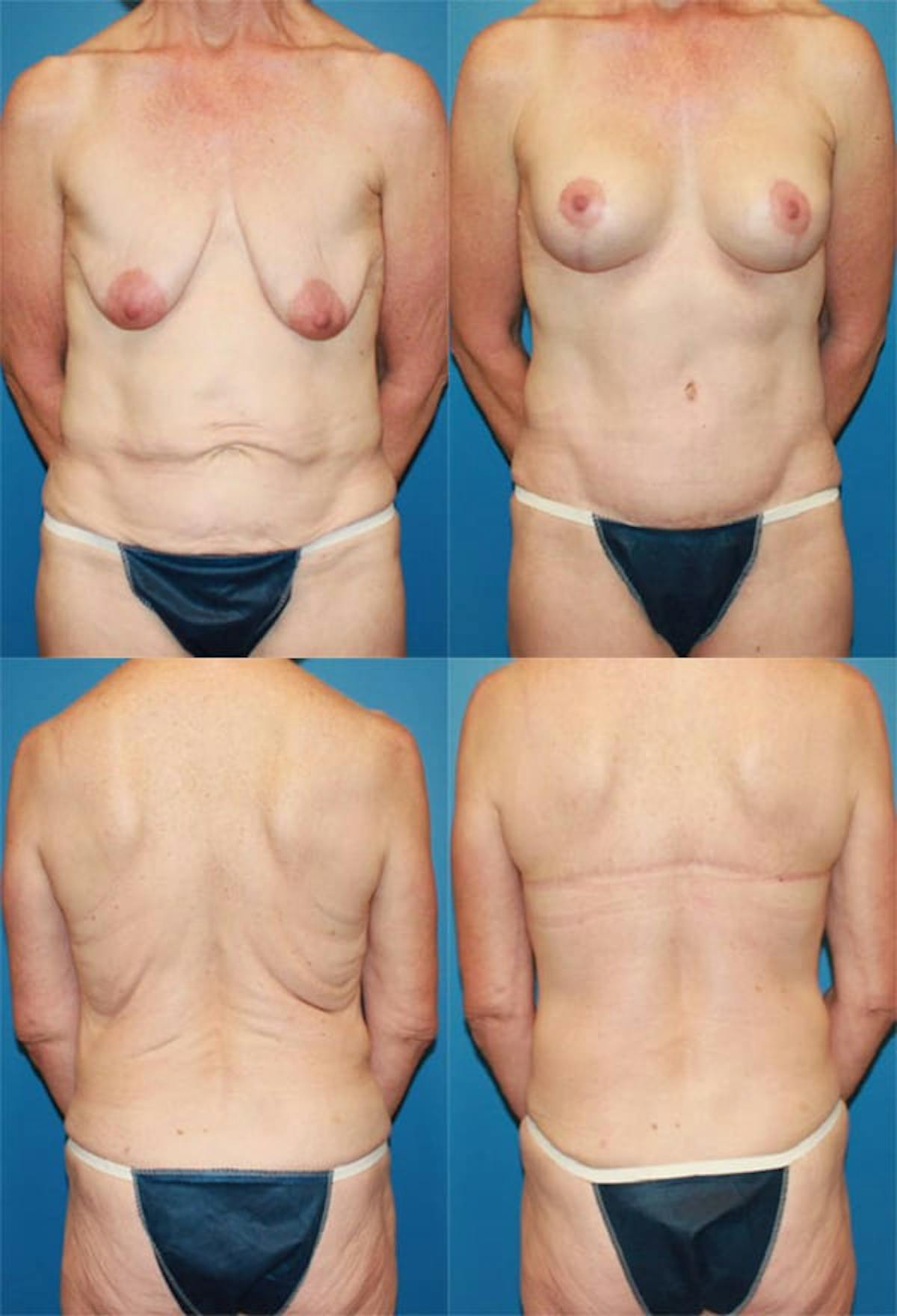 Body Lift / Thigh Lift Before & After Gallery - Patient 277581 - Image 1