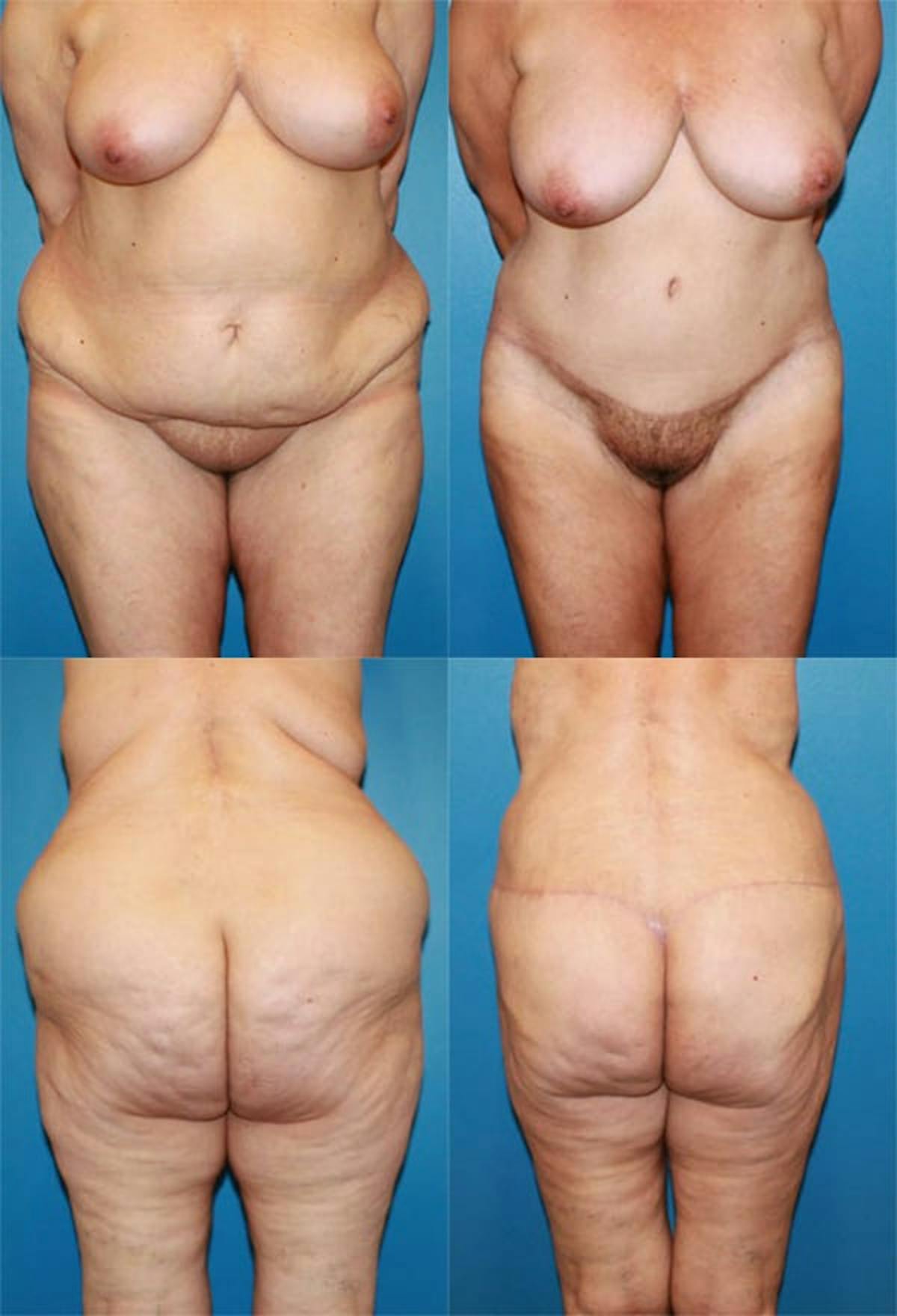 Body Lift / Thigh Lift Before & After Gallery - Patient 187702 - Image 1