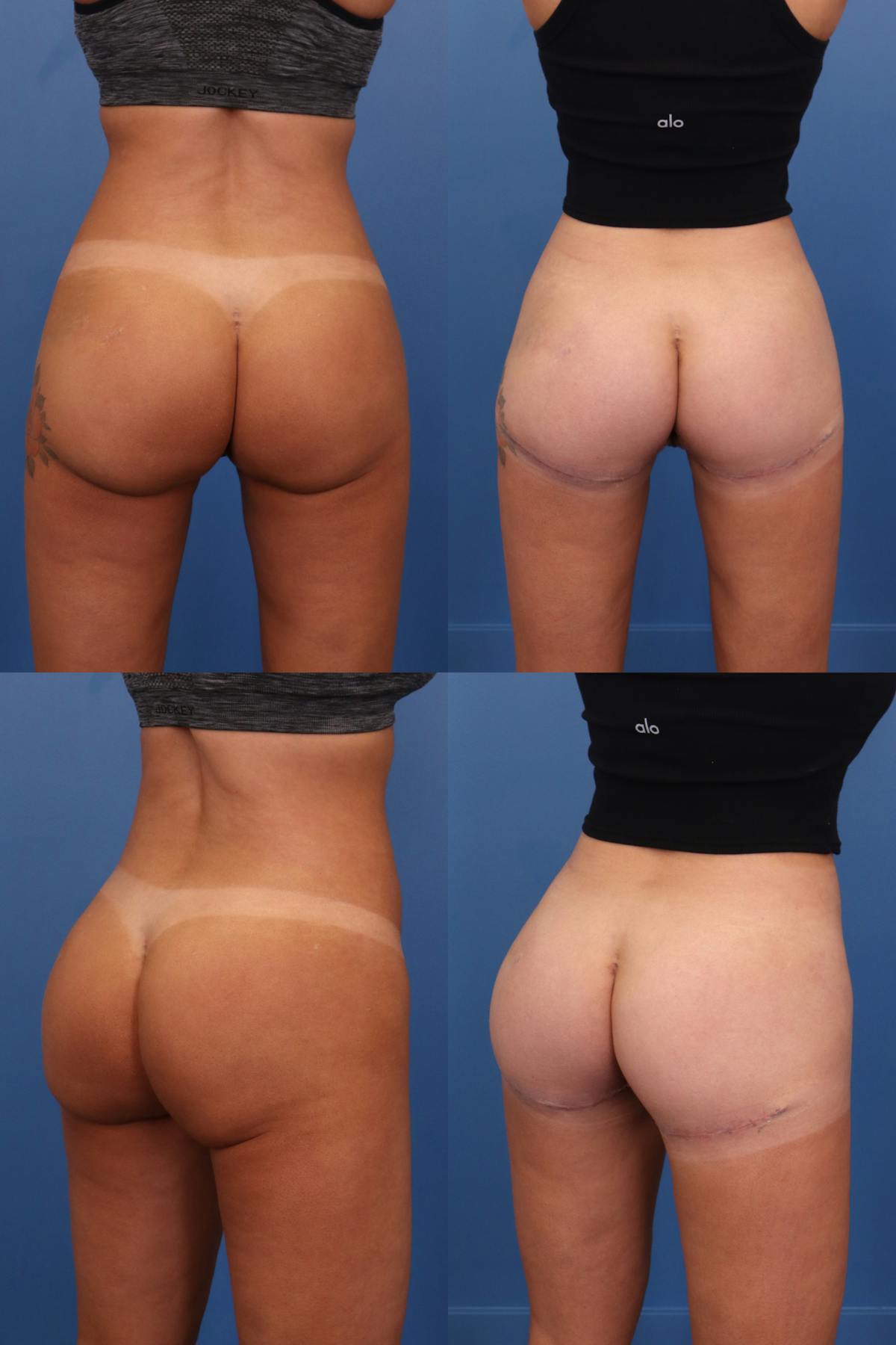 Thong Lift / Infragluteal Thigh Lift Before & After Gallery - Patient 445960 - Image 1