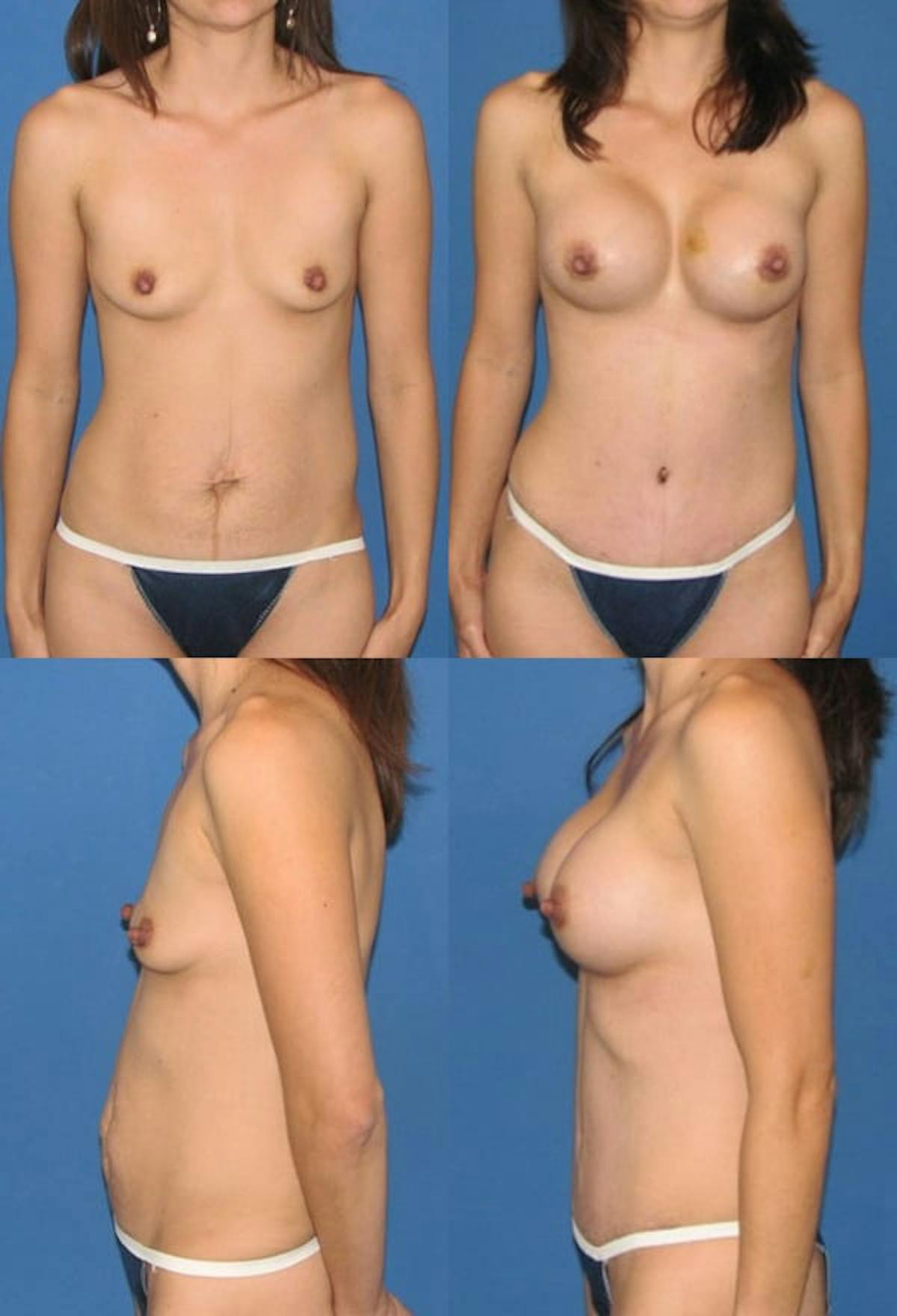 Tummy Tuck Before & After Gallery - Patient 417934 - Image 1