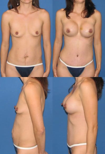 Tummy Tuck Before & After Gallery - Patient 417934 - Image 1