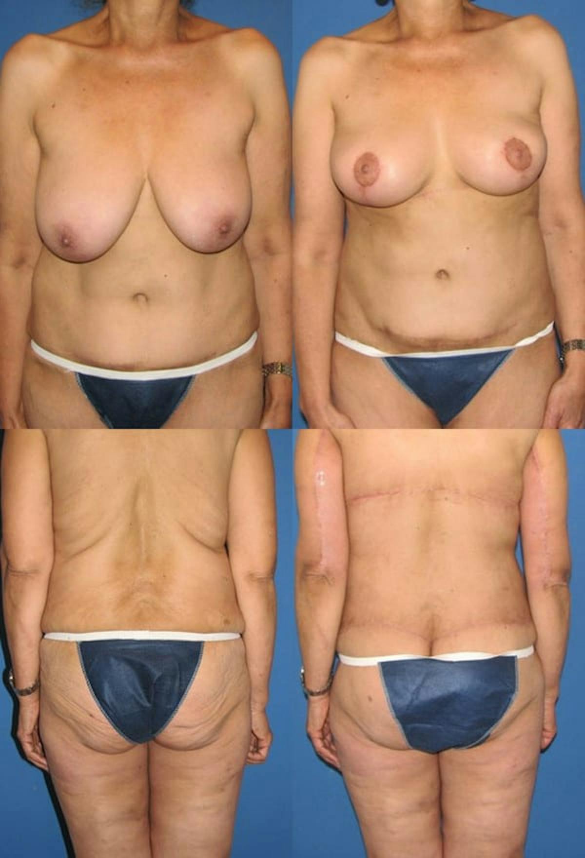 Body Lift / Thigh Lift Before & After Gallery - Patient 321193 - Image 1