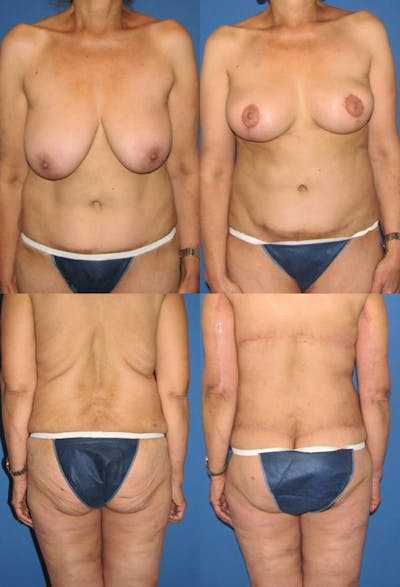Body Lift / Thigh Lift Before & After Gallery - Patient 321193 - Image 1
