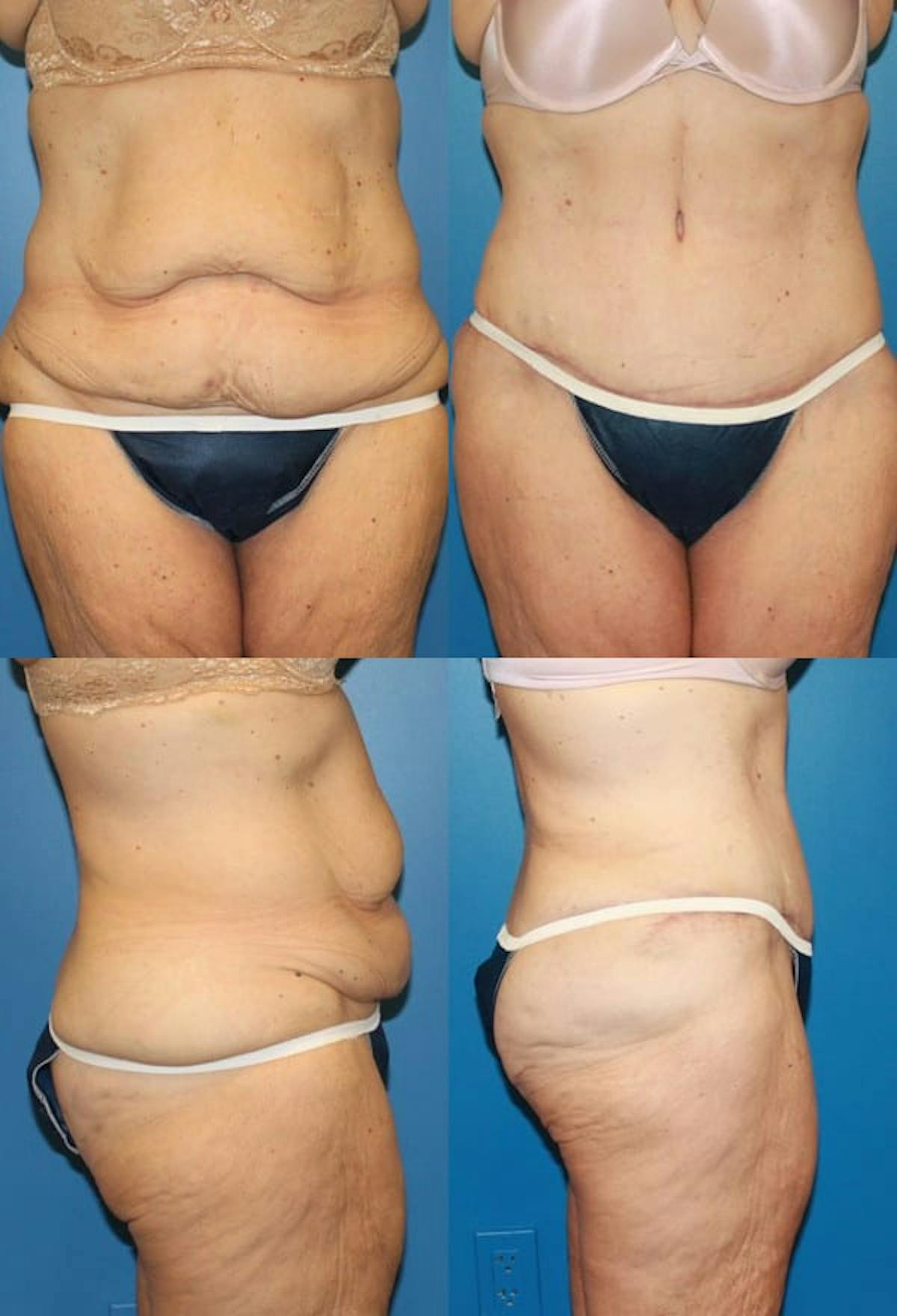 Tummy Tuck Before & After Gallery - Patient 104920 - Image 1