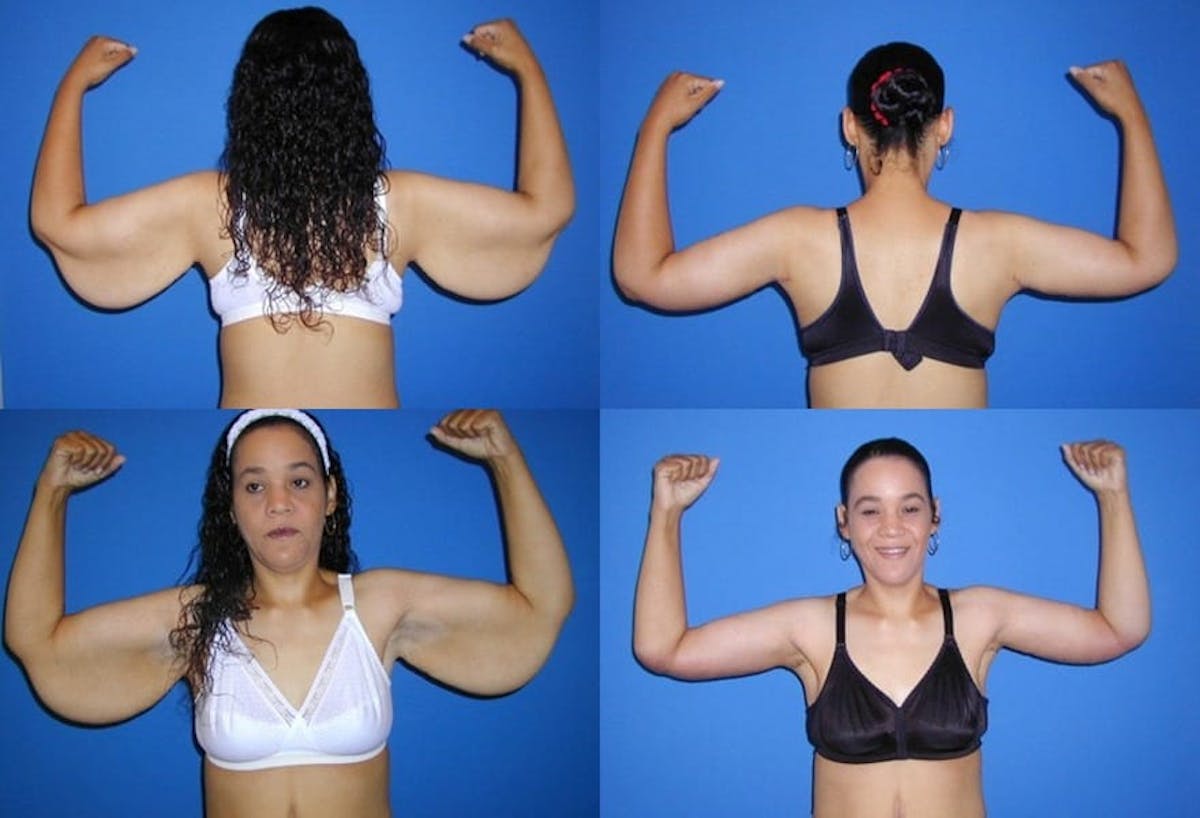 Arm Lift Before & After Gallery - Patient 224226 - Image 1