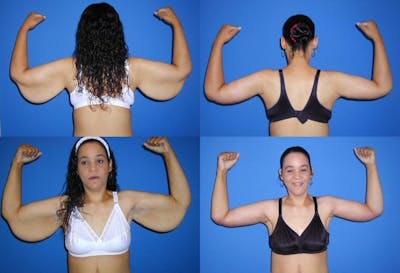 Arm Lift Before & After Gallery - Patient 224226 - Image 1