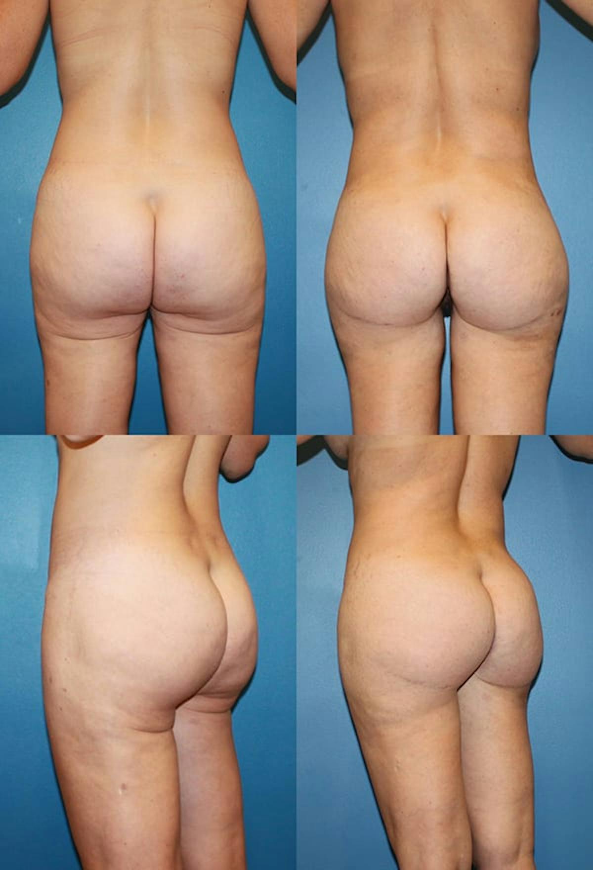 Thong Lift / Infragluteal Thigh Lift Before & After Gallery - Patient 323528 - Image 1