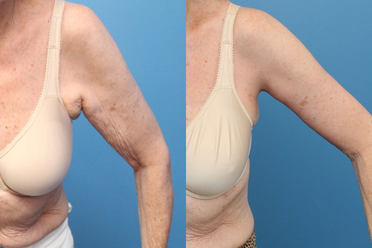 Arm Lift Before & After Gallery - Patient 633536 - Image 1