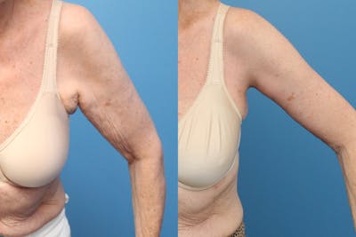 Arm Lift Before & After Gallery - Patient 633536 - Image 1