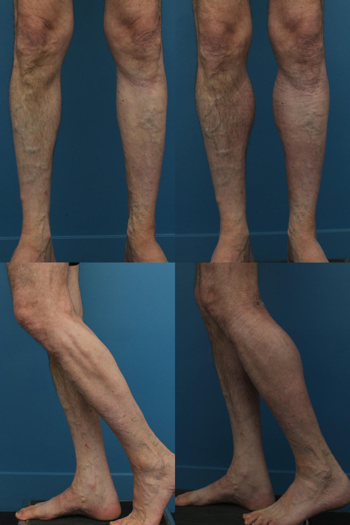 Calf Augmentation Before & After Gallery - Patient 272698 - Image 1