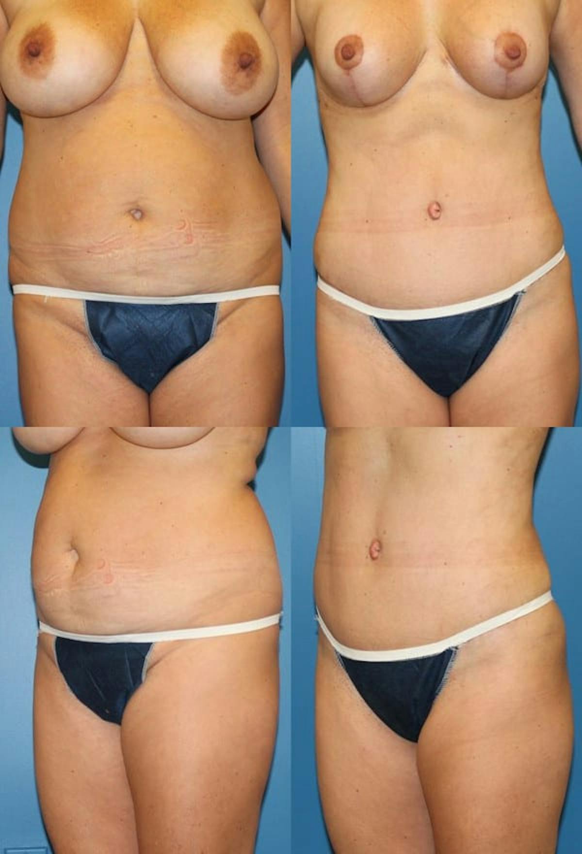 Tummy Tuck Before & After Gallery - Patient 244950 - Image 1
