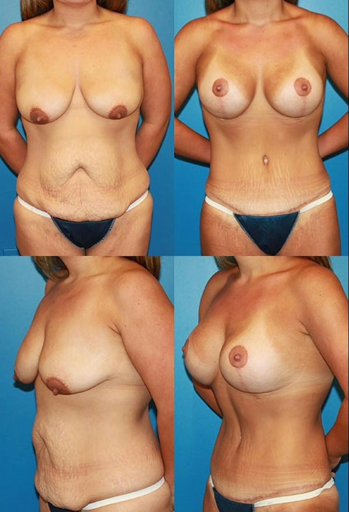 Tummy Tuck Before & After Gallery - Patient 248218 - Image 1