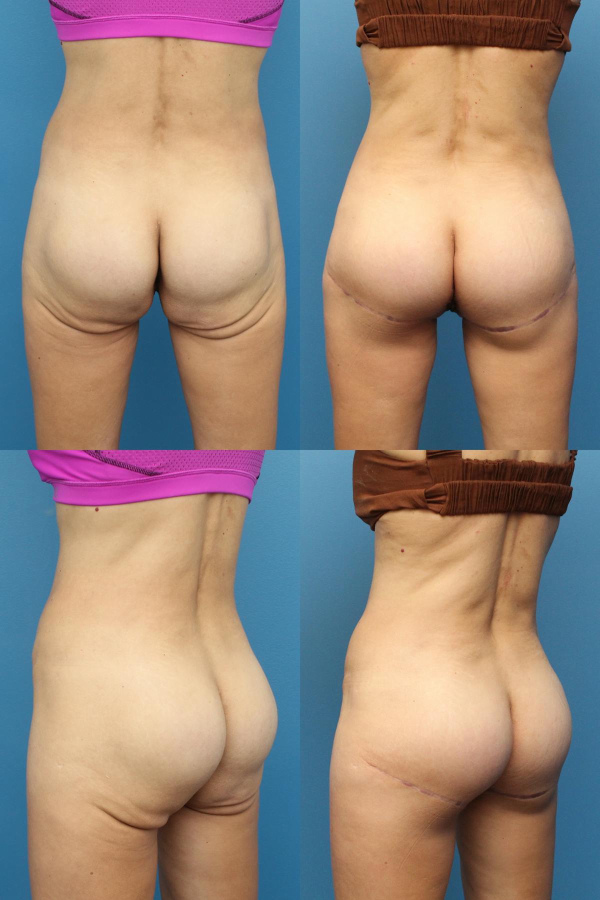 Thong Lift / Infragluteal Thigh Lift Before & After Gallery - Patient 357933 - Image 1