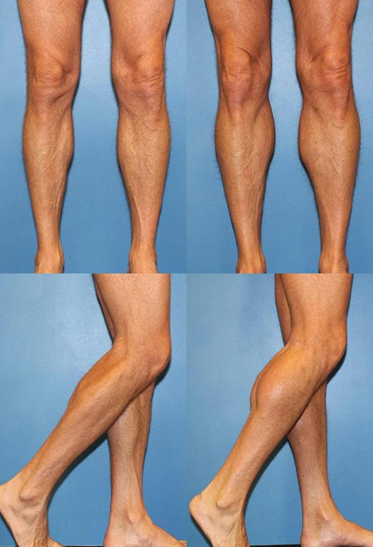 Calf Augmentation Before & After Gallery - Patient 108588 - Image 1