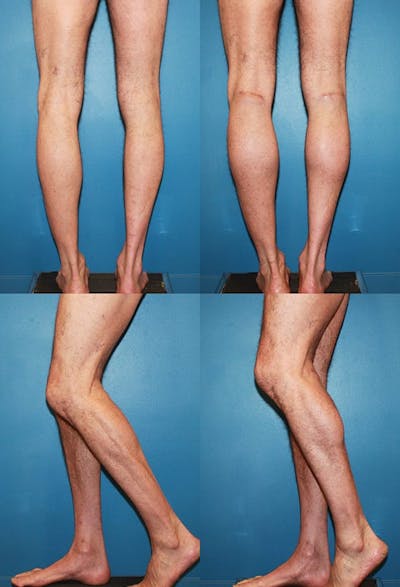 Calf Augmentation Before & After Gallery - Patient 847395 - Image 1
