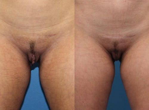 Patient 1 Before - Labiaplasty