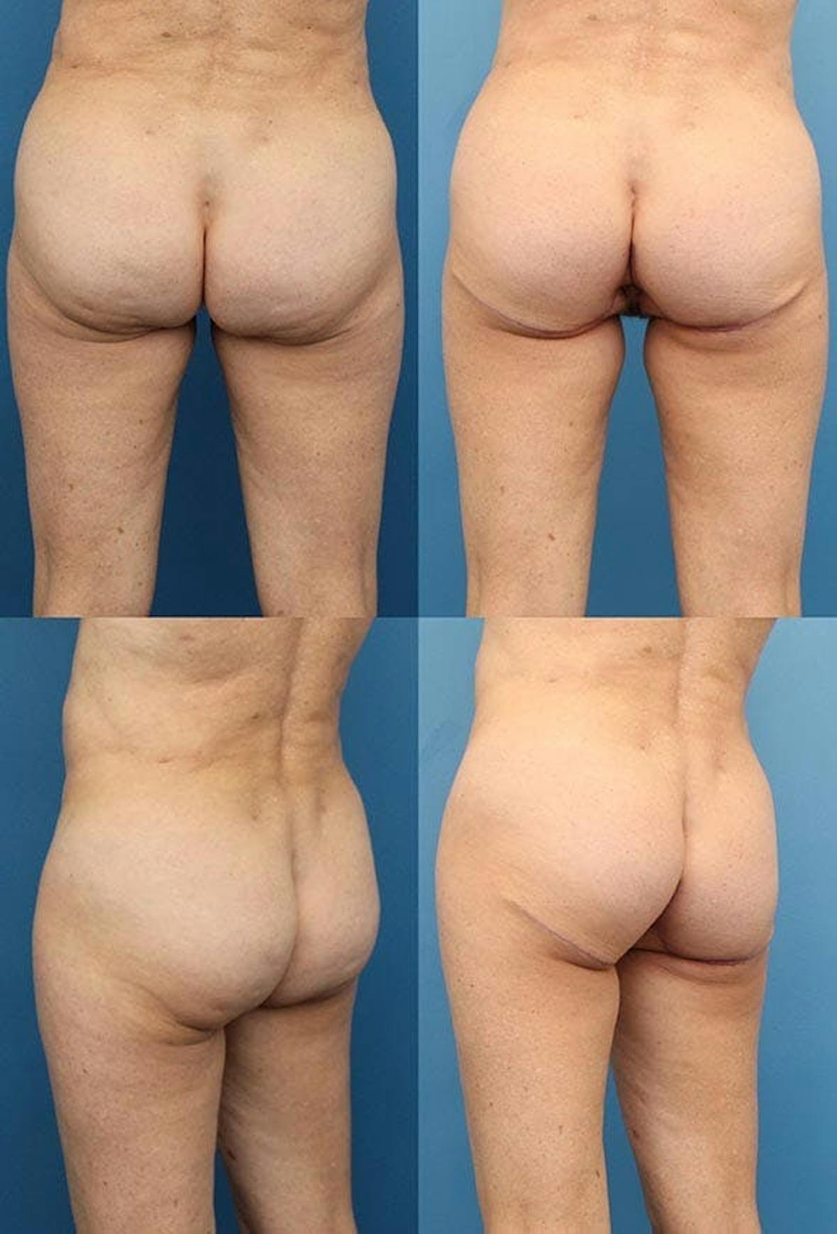 Thong Lift / Infragluteal Thigh Lift Before & After Gallery - Patient 368846 - Image 1