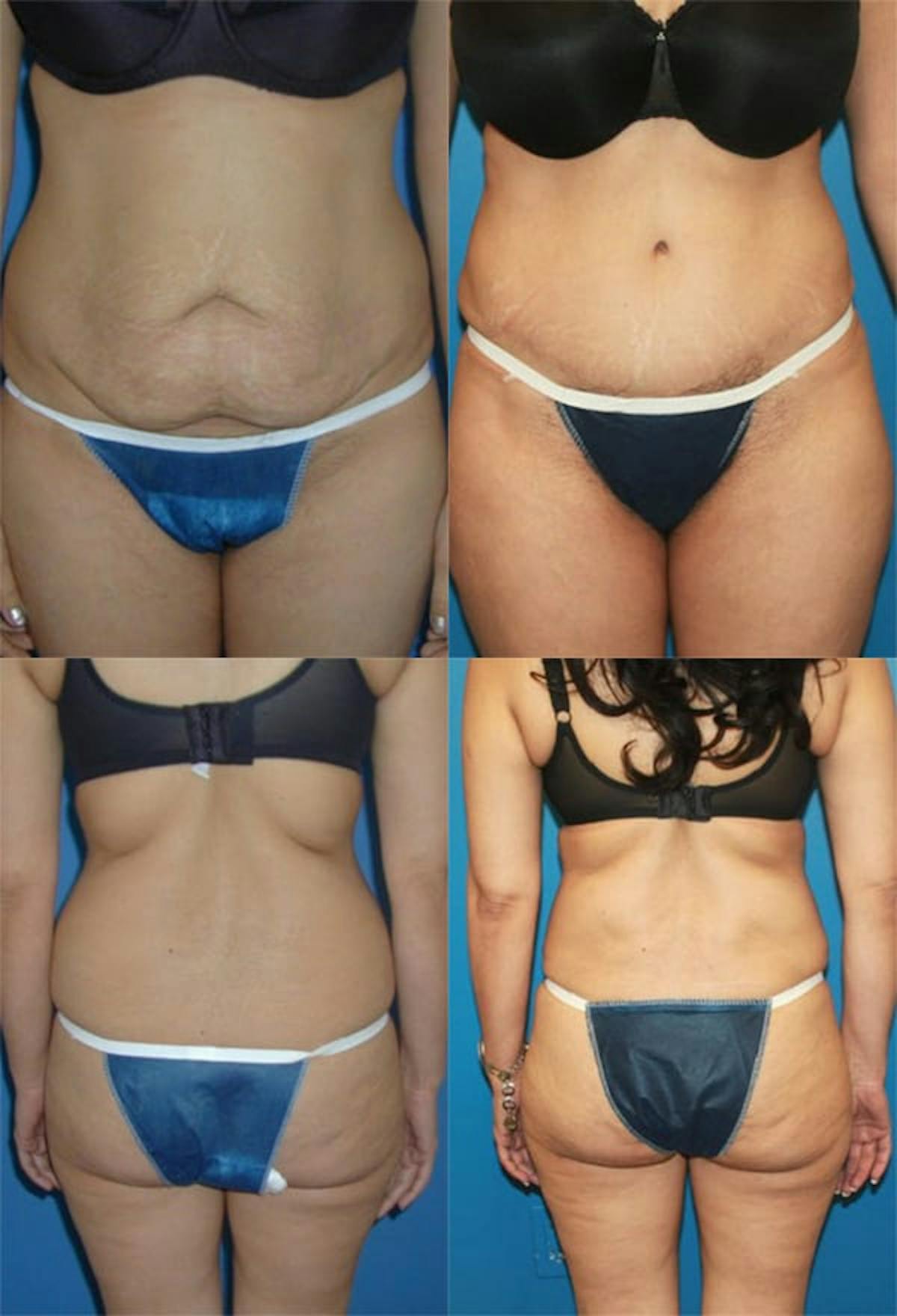 Tummy Tuck Before & After Gallery - Patient 345957 - Image 1