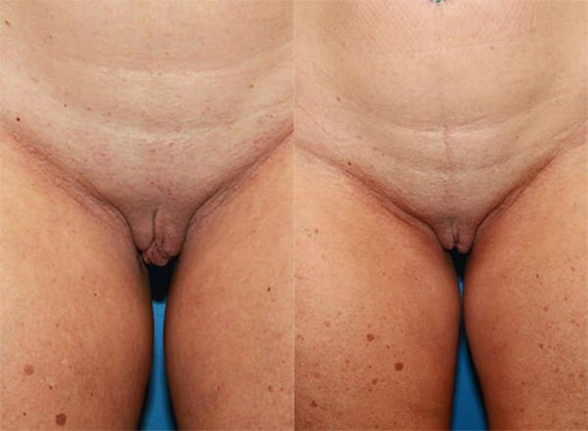 Labiaplasty Before & After Gallery - Patient 113062 - Image 1