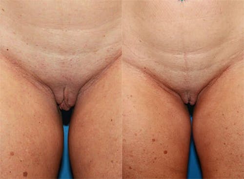 Patient 2 Before - Labiaplasty