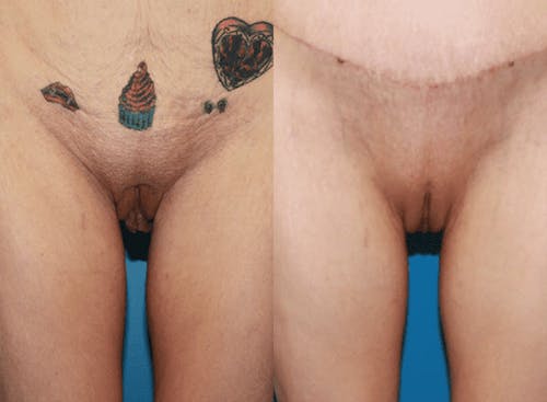 Patient 3 Before - Labiaplasty