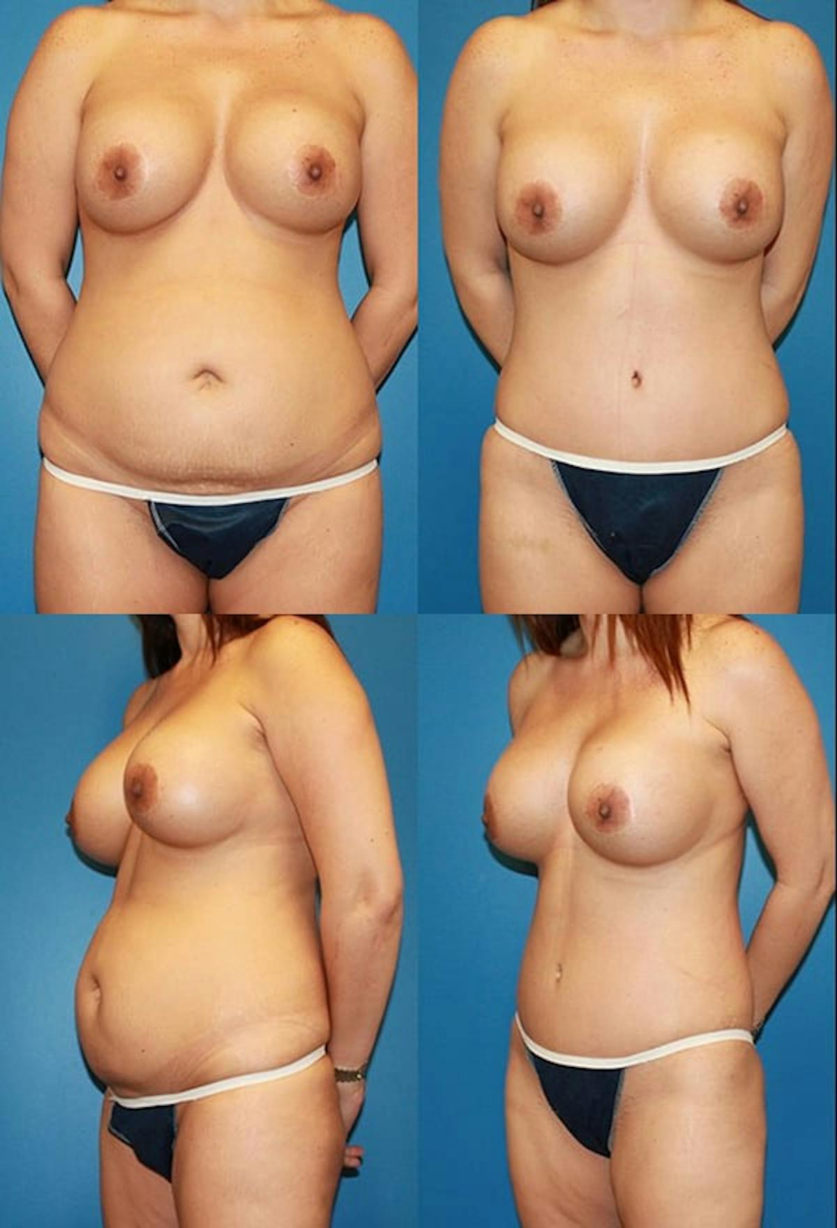 Tummy Tuck Before & After Gallery - Patient 307603 - Image 1