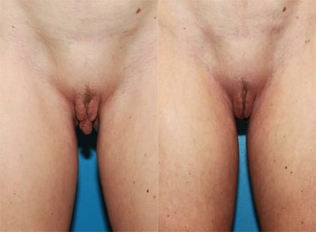 Labiaplasty Before & After Gallery - Patient 179959 - Image 1