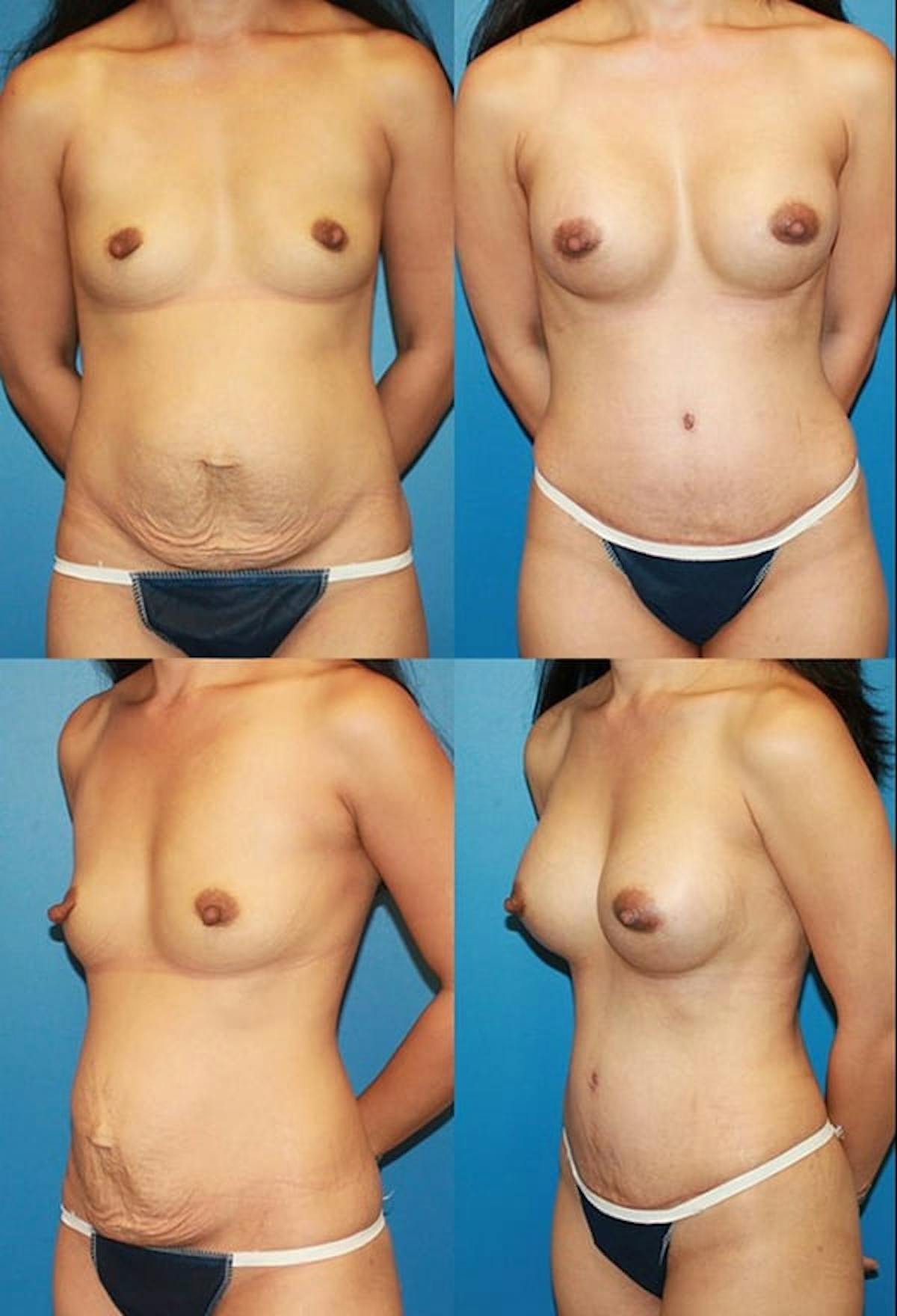 Tummy Tuck Before & After Gallery - Patient 258094 - Image 1