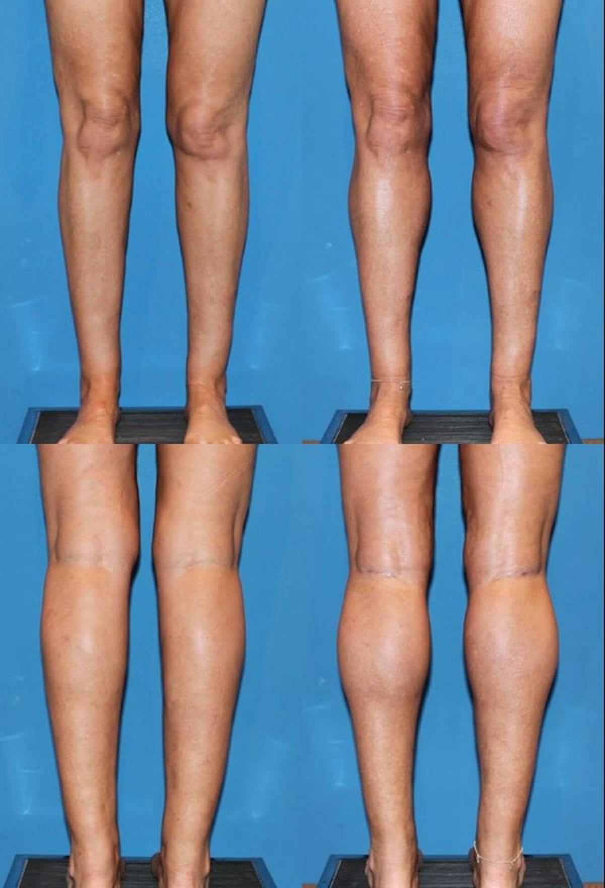 Calf Augmentation Before & After Gallery - Patient 322520 - Image 1