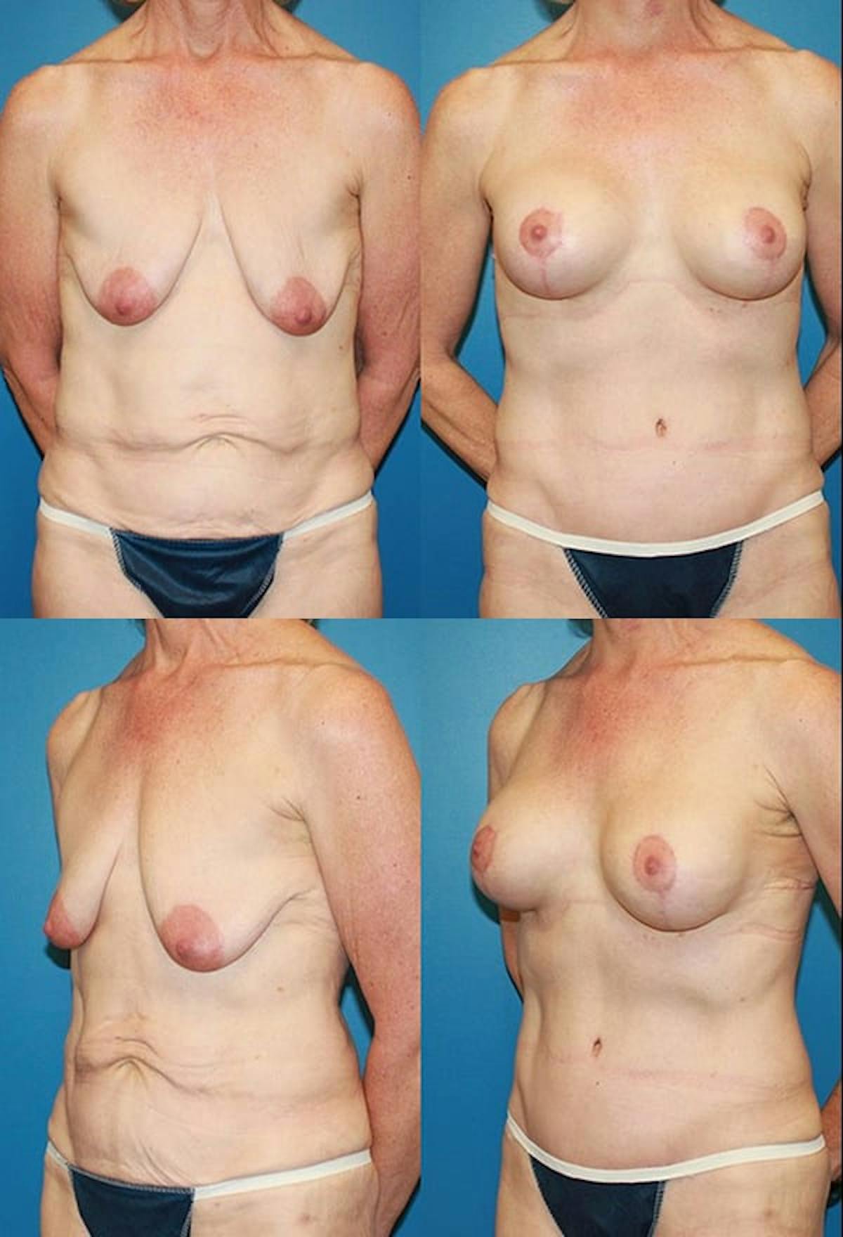 Tummy Tuck Before & After Gallery - Patient 350744 - Image 1