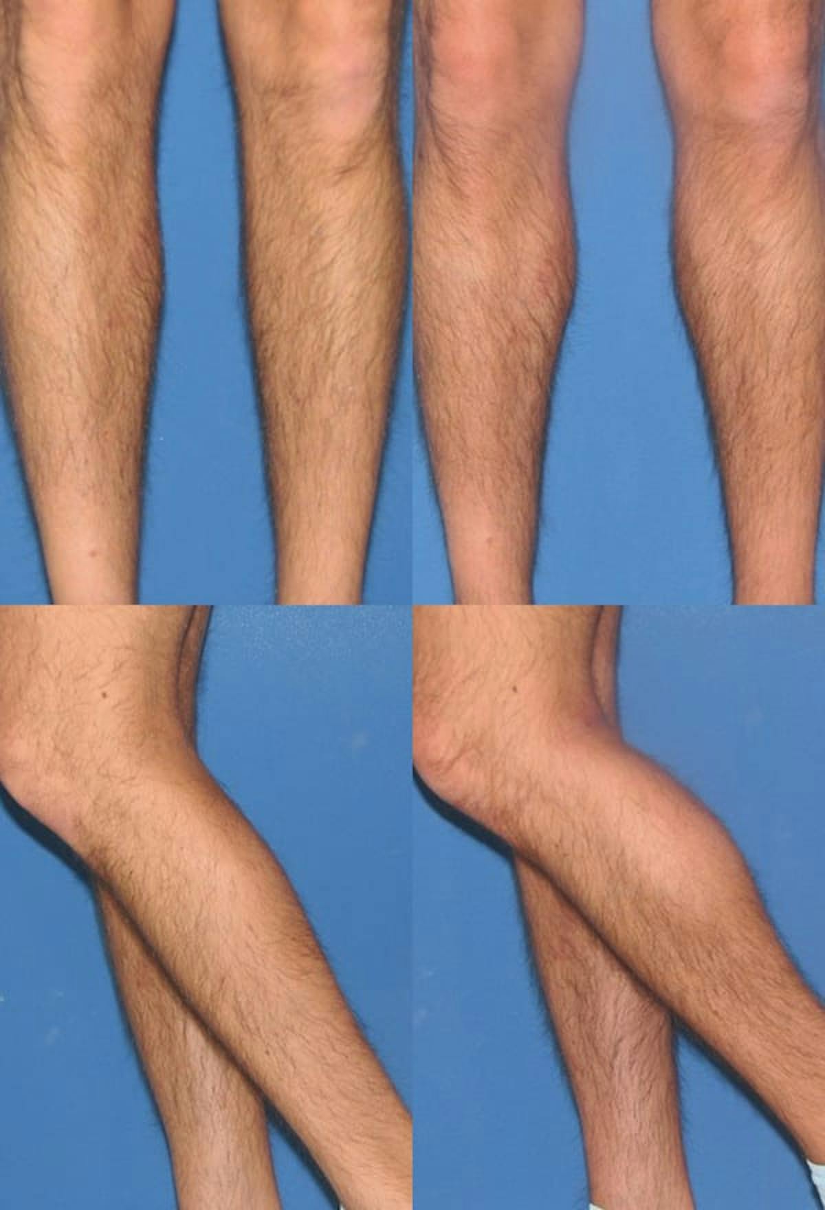 Calf Augmentation Before & After Gallery - Patient 360692 - Image 1