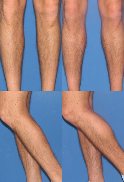 Calf Augmentation Before & After Gallery - Patient 360692 - Image 1
