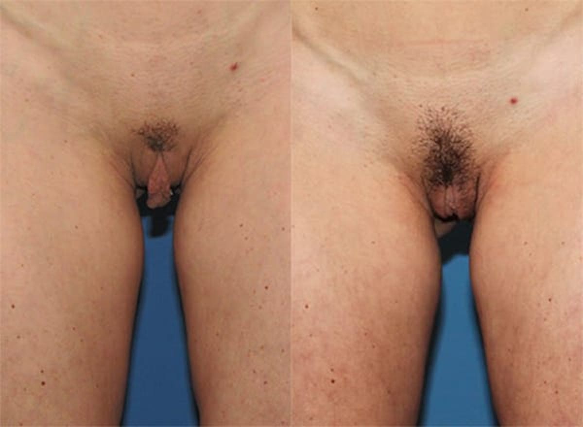 Labiaplasty Before & After Gallery - Patient 378342 - Image 1