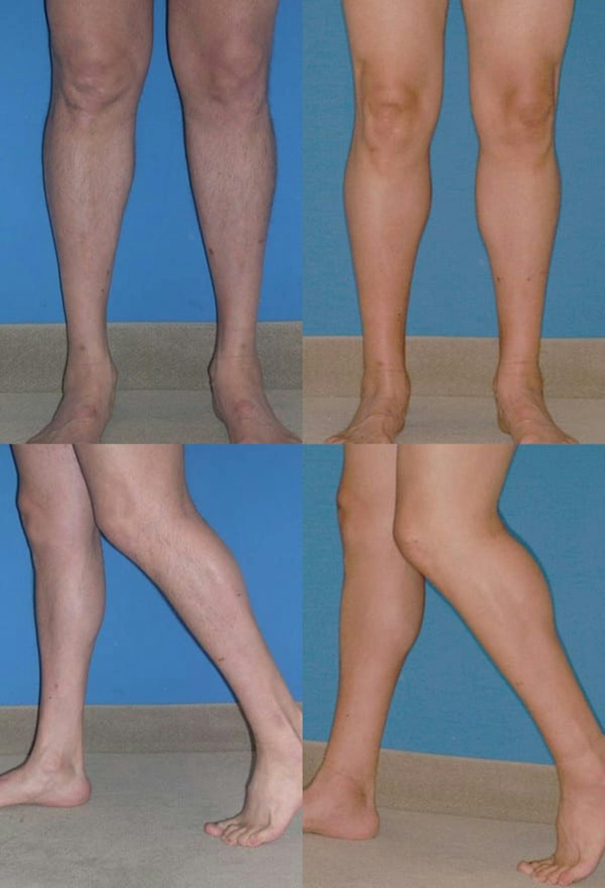 Calf Augmentation Before & After Gallery - Patient 422933 - Image 1