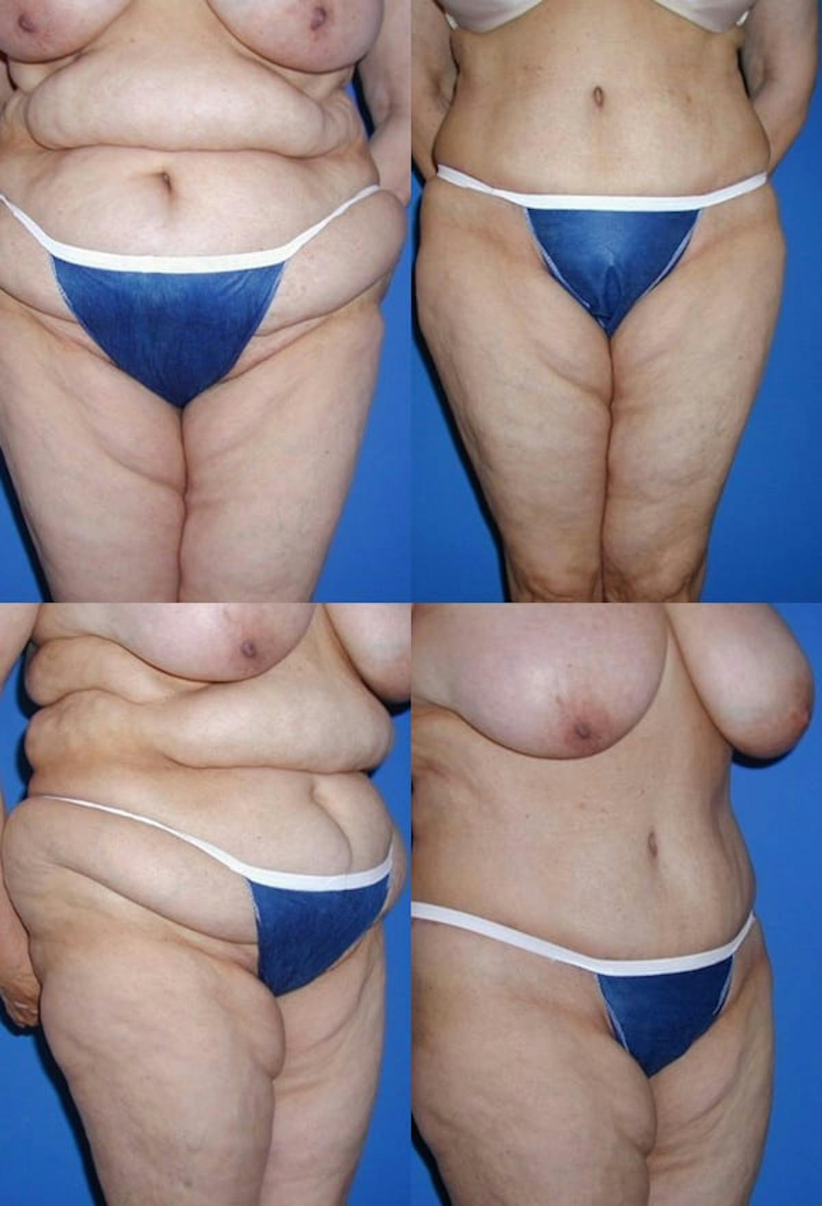 Tummy Tuck Before & After Gallery - Patient 418716 - Image 1
